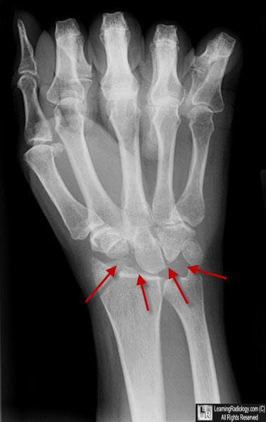 Proximal carpectomy